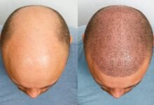 Breakthrough Hair Loss Treatment Shows Results in 20 Days