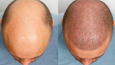 Breakthrough Hair Loss Treatment Shows Results in 20 Days