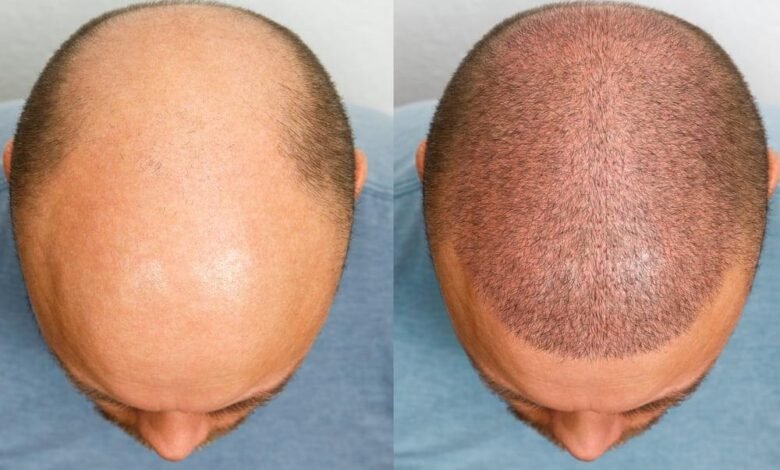 Breakthrough Hair Loss Treatment Shows Results in 20 Days - Magazine Breakthrough Hair Loss Treatment Shows Results in 20 Days Breakthrough Hair Loss Treatment Shows Results in 20 Days